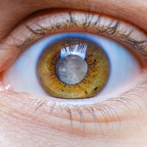 cataract